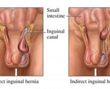Hernia